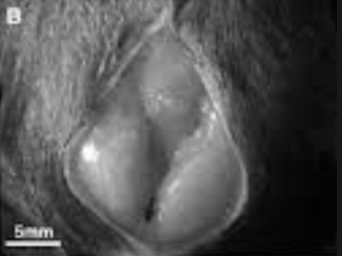 بروستاتا متضخمة — قبل الدعم